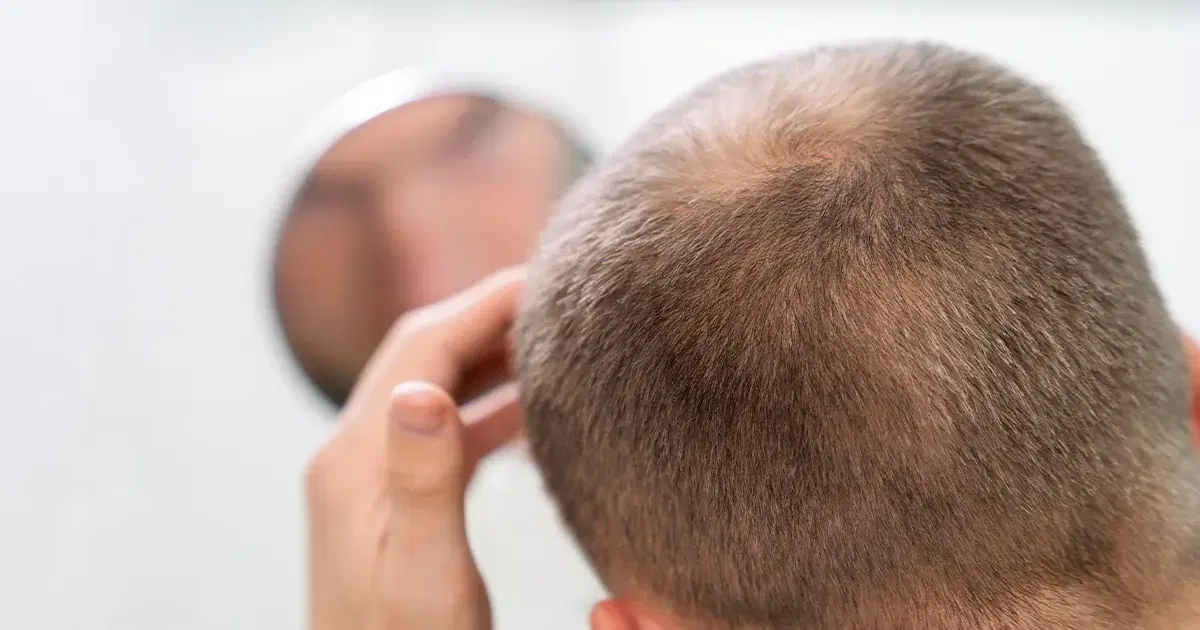 Hair Loss: Causes, Symptoms, and Effective Treatments
